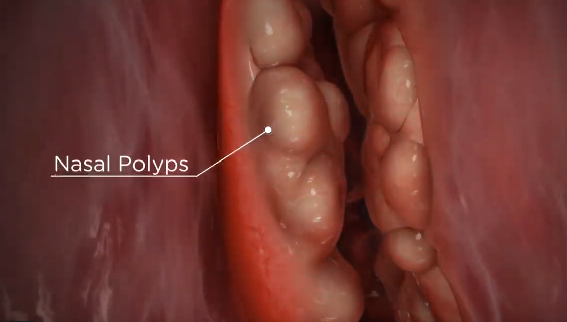 obstructive nasal polyps